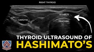 Thyroid Ultrasound of Hashimotos [upl. by Tut]