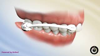 Carriere Class II Motion with Lower Lingual Arch  Dental Braces  Temecula Valley CA [upl. by Lacee27]