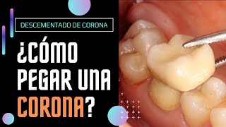 Cómo PEGAR UN DIENTE ROTO o CORONA DENTAL DESPEGADA de forma provisional  shorts [upl. by Sucramaj538]