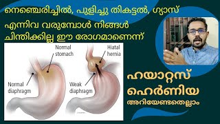 116 Hiatus Hernia  Symptoms causes amp treatment  Ayurveda  Malayalam  Dr Jishnu Chandran [upl. by Ydnelg]