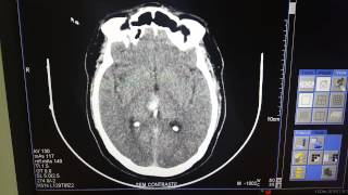 tomografia de crânio sc [upl. by Lawtun]