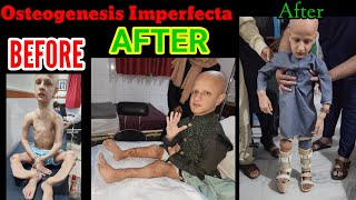 Osteogenesis Imperfecta CASE 1Video 6 Started Standing amp Taking Steps after 18 years of waiting [upl. by Amathiste]