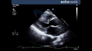 TheEchoWeb  Perimembranous Ventricular Septal Defect [upl. by Ellatnahc373]