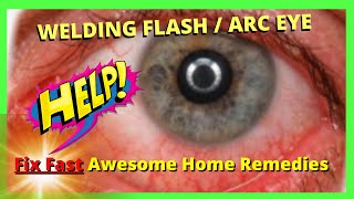 Welding Flash  Arc Eye Best 11 Home Remedies [upl. by Rekoob]