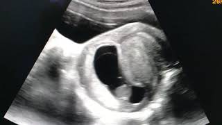 Retroflexed uterus USG Ultrasound [upl. by Surbeck]