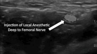 Ultrasound Guided Femoral Nerve Block [upl. by Valerlan750]