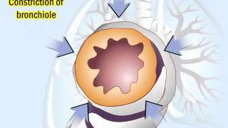 COPD Pathophysiology and Diagnosis [upl. by Jerrilyn]