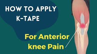 How to treat Knee pain Patellofemoral syndrome  tendonopathy using Kinesiology Tape [upl. by Sabsay760]