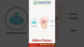 Learn All About Pessaries with Dr Mohini  Urogynecology  Urogynecology amp Pelvic Health Care [upl. by Domash]