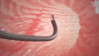 Endoscopic Sleeve Gastroplasty ESG [upl. by Malim]