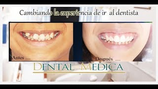 😮Brackets Linguales Antes Y Despues 😁 CLINICA DENTAL VELEZ Doctor Erick Vélez [upl. by Gnay]