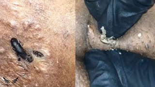 Severe Blackhead Removal  Cystic Elderly Acne Treatment  Whitehead Hidden Acne Spa Relaxing  142 [upl. by Arriet893]