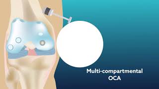 Using osteochondral allograft transplantation to treat articular cartilage lesions of the knee [upl. by Jasun752]