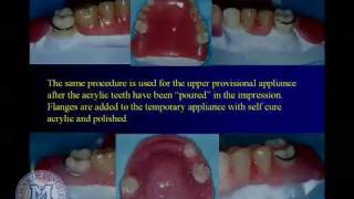 DENT 718 Repairing complete and partial dentures [upl. by Yatnuahc]