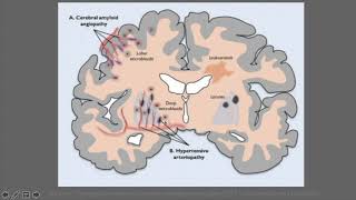 M4 Neuroradiologie à liECN Etiologies des AVC [upl. by Annahsed]