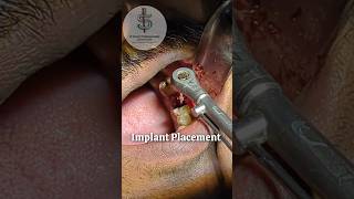 आरसीटी फेल हो गई  इंप्लांट कैसे किया Implant Placement Video Lower Molar drsparshnigam implant [upl. by Aronson]