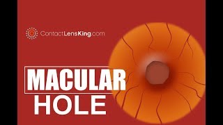 Macular Hole What Causes it and What are its Symptoms [upl. by Drapehs801]