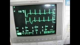 the valsalva maneuver and sinustachycardia  cardiac arrhythmia [upl. by Lak]