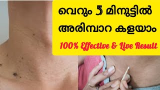 അരിമ്പാറ കളയാം 5 മിനുട്ടിനുള്ളിൽ  Arimpara Removal  Malayalam [upl. by Enitsua952]