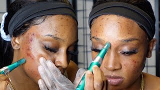 Microneedling at Home  Acne Scars Dark Spots Hyperpigmentation ft Dr Pen A6S [upl. by Neenaej368]