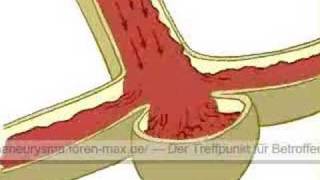 Die Entstehung eines AneurysmasHirnaneurysmas [upl. by Allisirp]