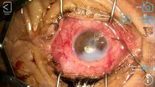 Ablation de silicone sur un œil monophtalme et glaucomateux œil opéré de décollement vitrectomie [upl. by Guerra]