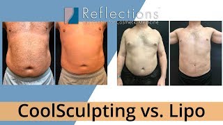 CoolSculpting vs Lipo Which is Better Price Downtime Pain [upl. by Ettevets]