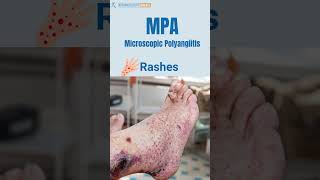 MPA Vasculitis Microscopic Polyangiitis Signs  You Should Not Ignore [upl. by Roti]