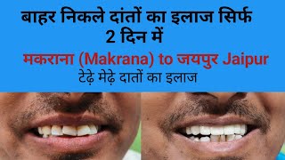 बाहर निकले दांतों का पक्का इलाज मकराना से जयपुर आये मरीज Smile makeover  smile [upl. by Suellen]