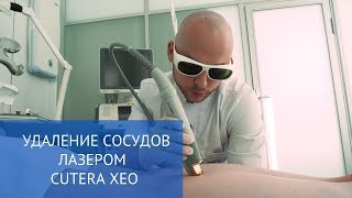 Удаление сосудов лазером Cutera XEO [upl. by Ardnasak369]