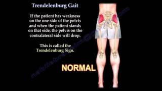 Trendelenburg Gait Everything You Need To Know Dr Nabil Ebraheim [upl. by Wurster834]