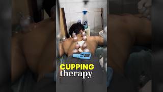 Cupping Therapy Cost 😳 amp Benefits 🙂‍↕️ [upl. by Adkins]