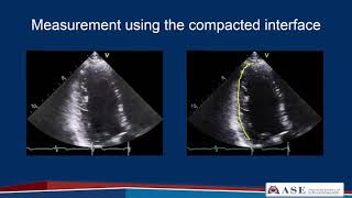 ASE Guidelines for Performing a Comprehensive Echo in Adults Part 2 [upl. by Eelsha]