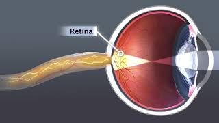 Animation Cataract [upl. by Gaspard]