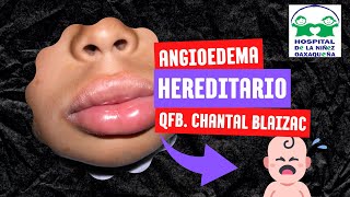 ANGIOEDEMA HEREDITARIO [upl. by Phare]