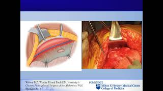 Parastomal Hernia Repair Techniques [upl. by Jael88]