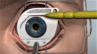 LASIK eye surgery  3D animation [upl. by Weidner837]