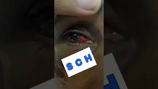 Subconjunctival Hemorrhage Part 4 Shorts SubconjunctivalHemorrhage [upl. by Nohj]