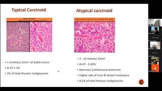 Carcinoid  Dr Lekshmi Priya Raj [upl. by Stockwell726]