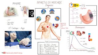 INFARCTUS DU MYOCARDE IDM  PHYSIOPATHOLOGIE ET DIAGNOSTIC [upl. by Ecirtael235]