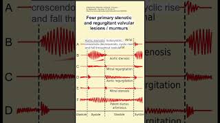 Four primary stenotic and regurgitant valvular lesions  murmurs [upl. by Lletnohs]