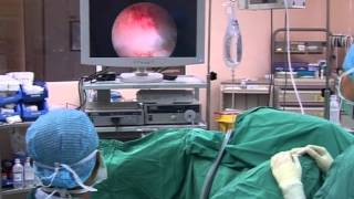 Operative Hysteroscopy Transcervical resection of myoma [upl. by Adnilra264]