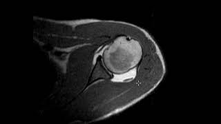 Labral tear in 20 year old [upl. by Nettle]