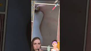 Blackheads Removal  Acne Treatment and Very Satisfying Satisfying Pimple pop blackheads [upl. by Anisamoht968]