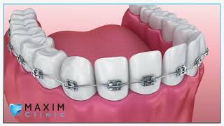 Orthodontie  Hoe werkt de slotjesbeugel [upl. by Ahsias]