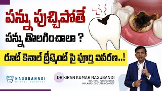 Root canal treatment  Treatment for tooth decay Health Dr Kiran Kumar  Nagubandi Dental Hospital [upl. by Faubion]