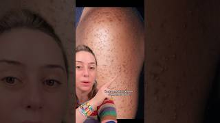 Acne vs Keratosis Pilaris shorts [upl. by Bennion]