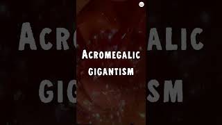 Acromegalic Gigantism How a Tumor Turns You Into a Giant [upl. by January410]