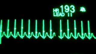 Taquicardia supraventricular con cardioversión sincronizada AS [upl. by Nussbaum]