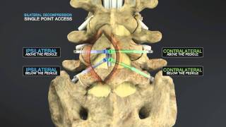 Medical Animation of Lumbar Stenosis Decompression [upl. by Philina]